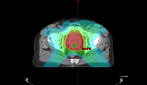 Prostate treatment plan