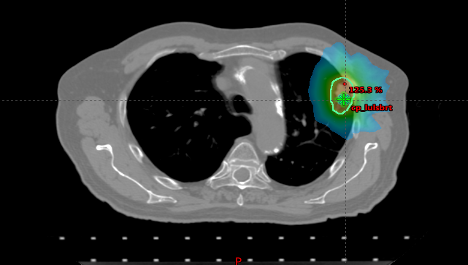 SBRT Treatment