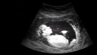 Fetal dosimetry image